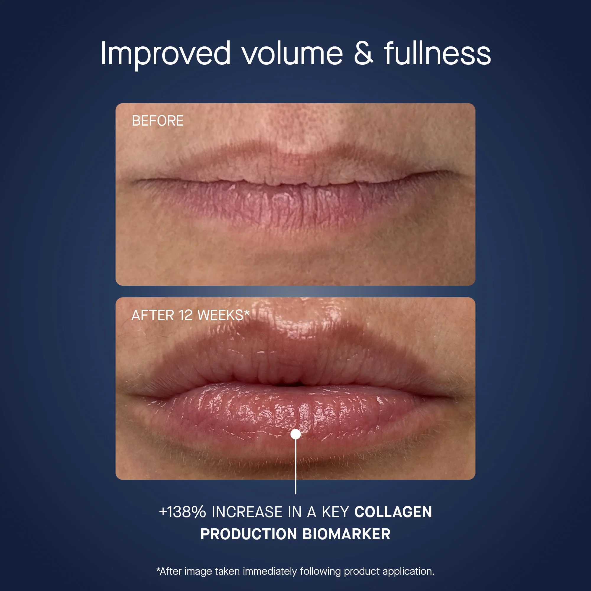 OS-01 LIP Mask, Recurring - Image 3